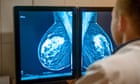 ‘Gamechanging’ breast cancer pill to be offered on NHS in England and Wales