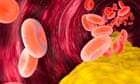 Lowering bad cholesterol may cut risk of dementia by 26%, study suggests