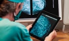 NHS England aims for faster cancer treatment with new data tool
