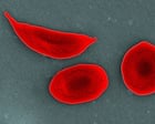 UK sickle cell patients ‘get worse care than sufferers of similar disorders’