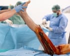 ‘Being short is a curse’: the men paying thousands to get their legs broken – and lengthened