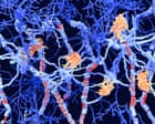 Two new subtypes of MS found in ‘exciting’ breakthrough