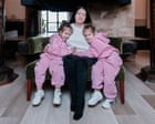 Experience: my daughters were born conjoined at the head